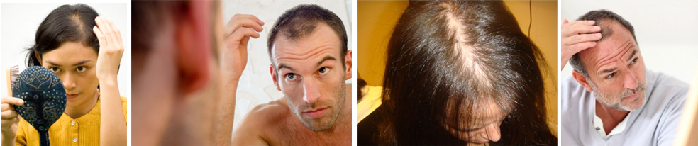 hair loss images